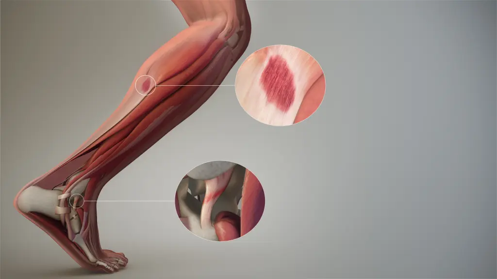 Fracture of ligament and tendon