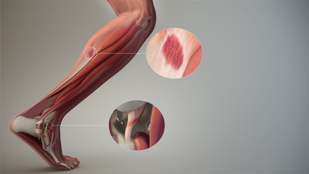 Fracture of ligament and tendon